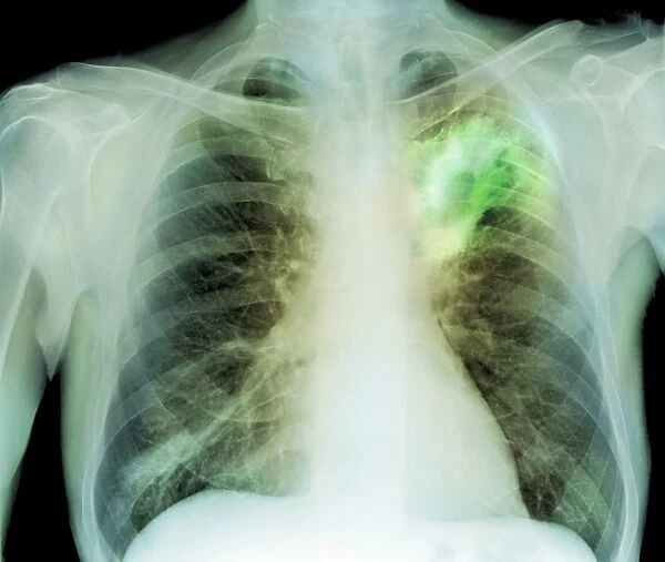 Lung abscess, X-ray
