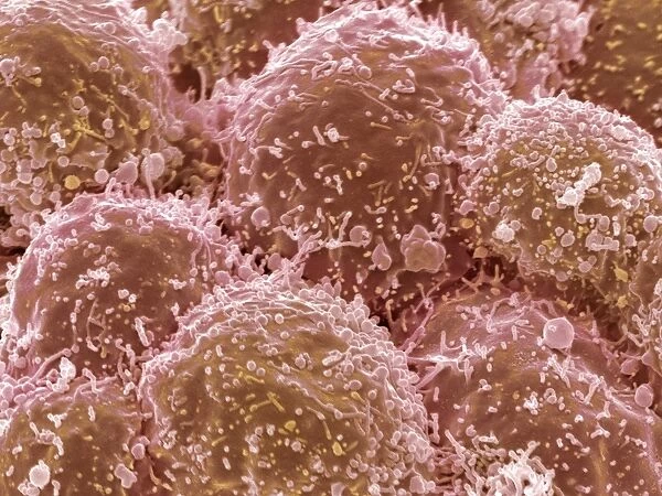 Lung cancer cells, SEM F006  /  8640