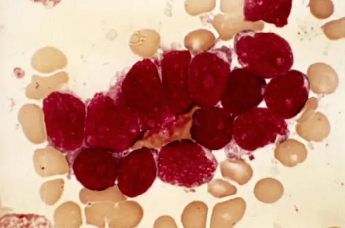 Framed Print : Lymphoblastic sarcoma print Framed Print : Lymphoblastic sarcoma print