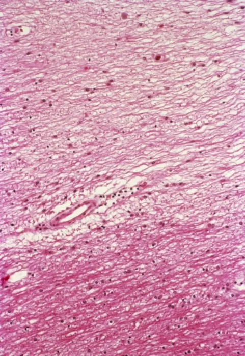 Framed Print : Multiple Sclerosis Brain Tissue Print Framed Print : Multiple Sclerosis Brain Tissue Print