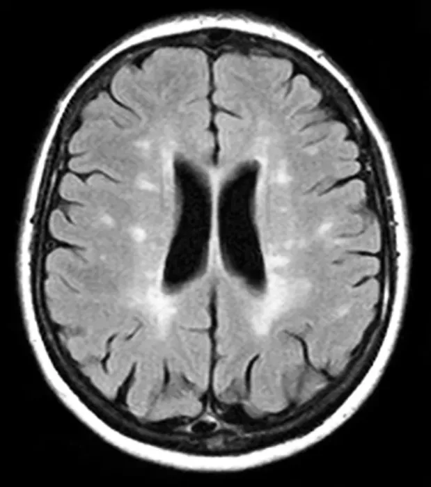 Framed Print : Multiple sclerosis MRI scan Print Framed Print : Multiple sclerosis MRI scan Print
