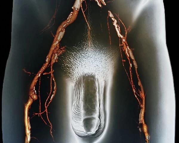 Narrowed arteries, 3D CT scan F006  /  9113