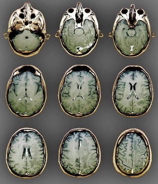 Normal brain, MRI scans