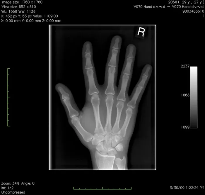 Framed Print : Digital X-ray Print of a Normal Right Hand Framed Print : Digital X-ray Print of a Normal Right Hand
