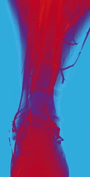Normal leg veins, angiogram