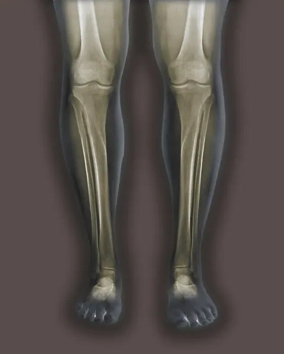 Framed Print : Coloured Frontal X-rays Print of Normal Legs Framed Print : Coloured Frontal X-rays Print of Normal Legs