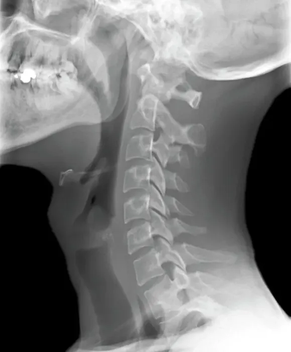 Framed Print : Normal neck, X-ray Print Framed Print : Normal neck, X-ray Print