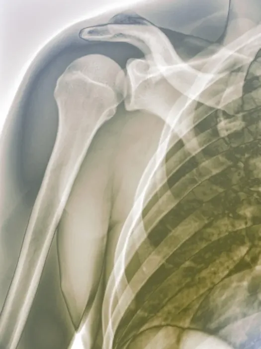 Framed Print : Colour X-ray Print of Normal Right Shoulder
