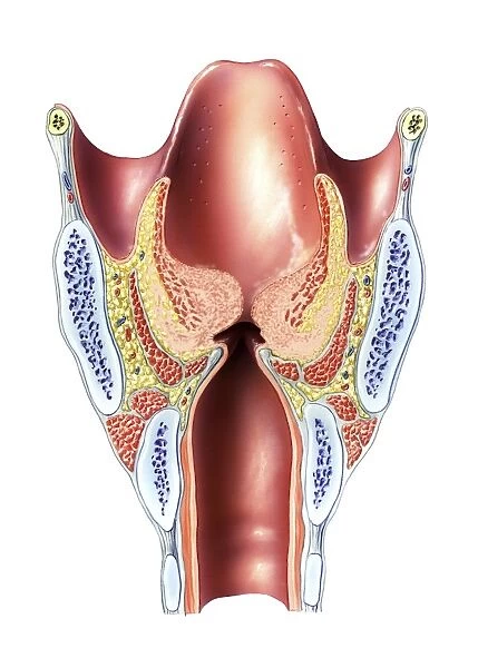Oedema of larynx, artwork C016  /  6528