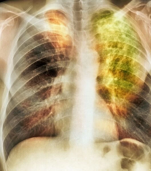 Old and new tuberculosis, X-ray