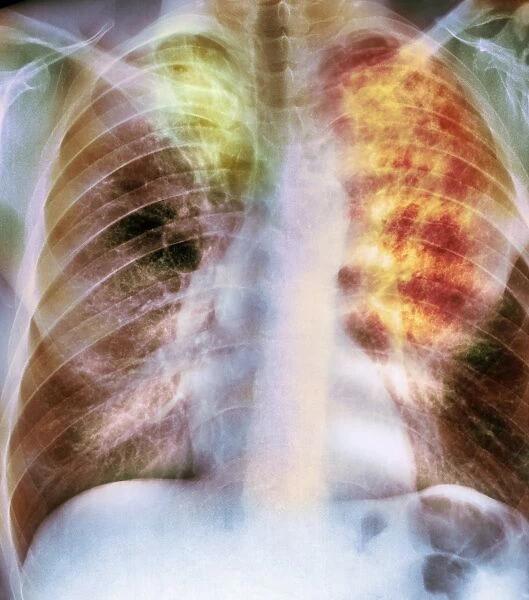 Old and new tuberculosis, X-ray