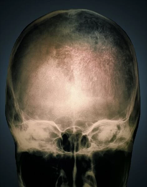 Osteoporosis in the skull, X-ray