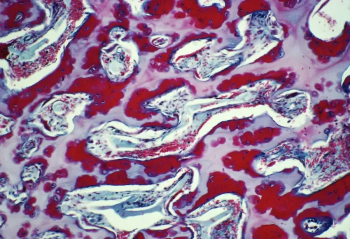 Framed Print : Osteoporotic bone Print Framed Print : Osteoporotic bone Print