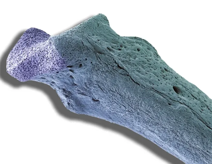Framed Print : Osteoporotic bone print, SEM Framed Print : Osteoporotic bone print, SEM