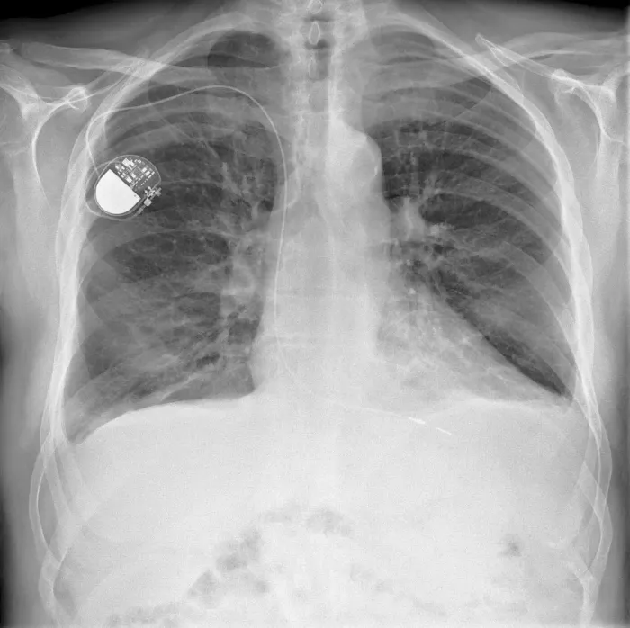 Framed Print : Pacemaker Print, X-ray Image Framed Print : Pacemaker Print, X-ray Image