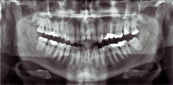 Panoramic dental X-ray