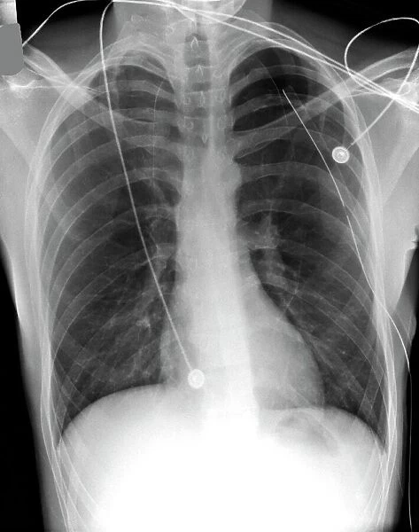 Pneumothorax treatment, X-ray