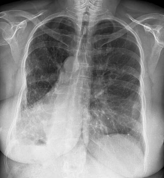 Reversed heart position, X-ray C017  /  7825