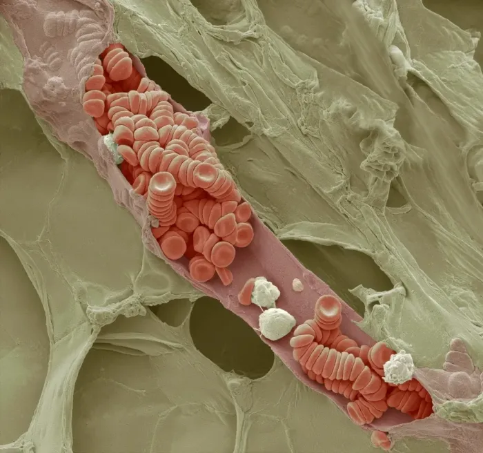 Framed Print : Ruptured Venule Print