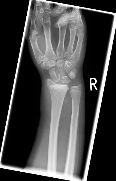 Salter Harris fracture, X-ray C017  /  7507
