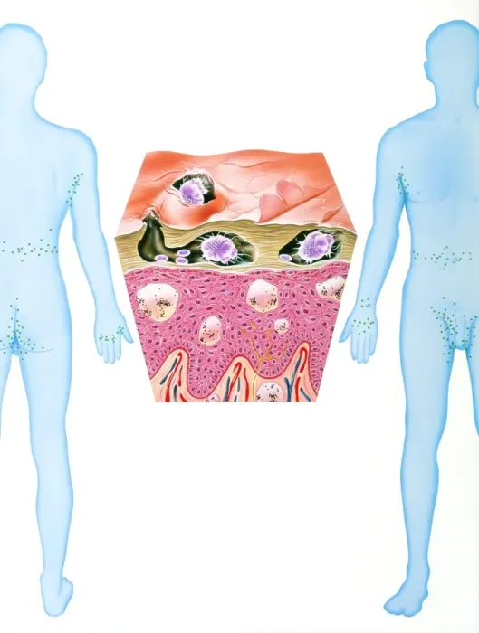 Framed Print : Scabies Mite Infestation Print Framed Print : Scabies Mite Infestation Print
