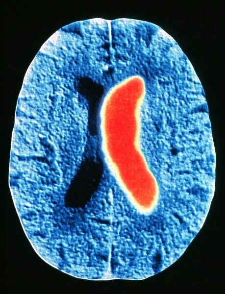 Stroke. Coloured computed tomography (CT) brain scan showing a cerebrovascular accident 