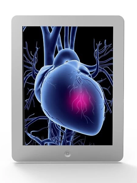 Tablet computer, heart attack artwork F006  /  4628