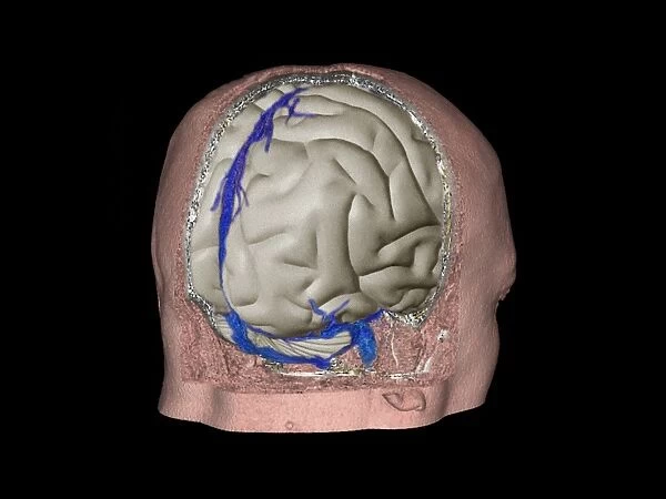 Thrombophlebitis in the brain, 3D CT scan