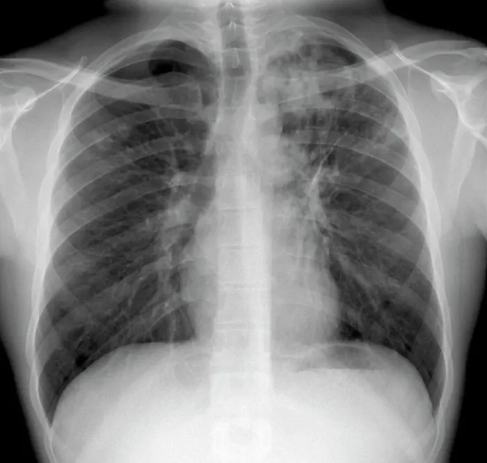 Framed Print : X-ray Print of Pulmonary Tuberculosis Framed Print : X-ray Print of Pulmonary Tuberculosis