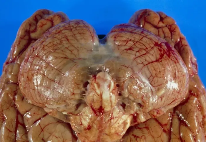 Framed Print : View of the underside of a human brain affected by meningitis, print Framed Print : View of the underside of a human brain affected by meningitis, print