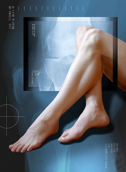 Womans legs, with knee X-ray