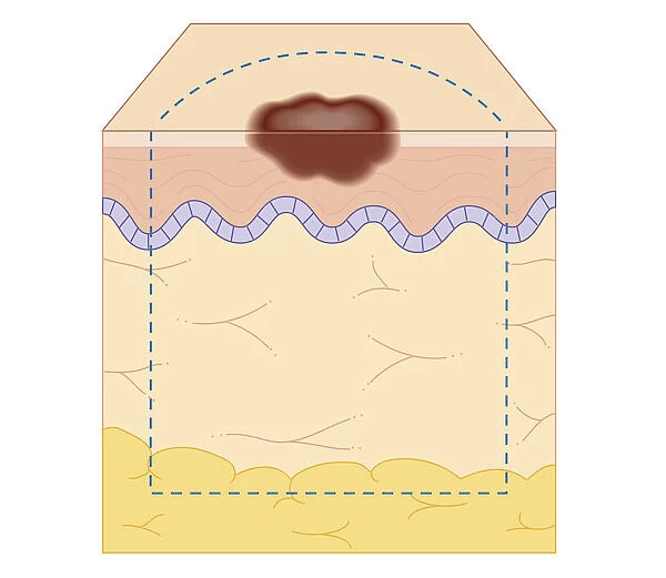 Cross section biomedical illustration of site of skin biopsy