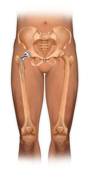 Front view of a body showing a total hip replacement