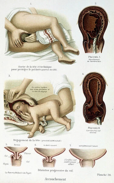 Childbirth - scientific board, late 19th century