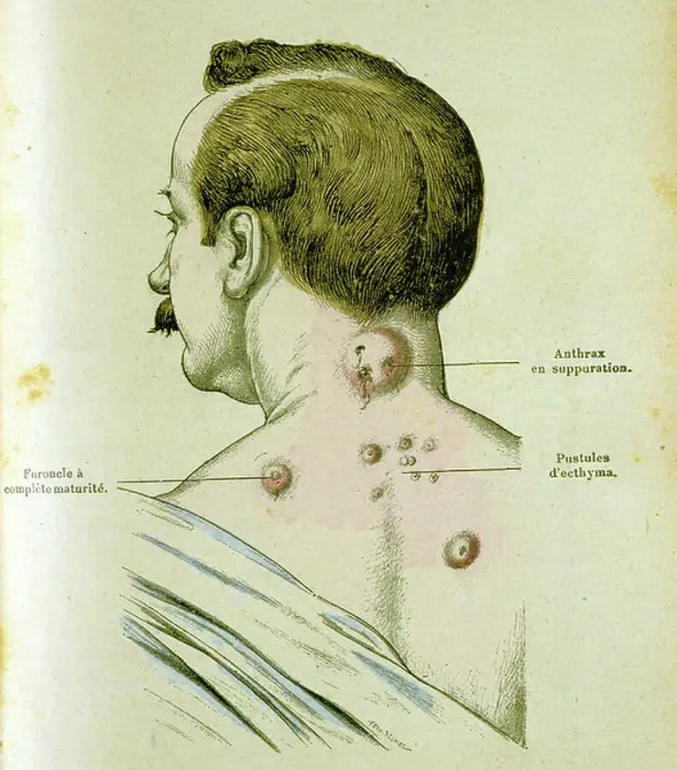 Framed Print : Anthrax Pustules Development Print, 19th Century Engraving