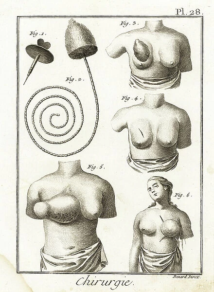 Trocade a tracheotomy, brush for the stomach, tumour in the chest after Lorenz Heister, scar after the elimination of the tumour, and ancient harmful and painful method of tracheotomy - Plate drawn from '' The Encyclopedie'' by Denis Diderot