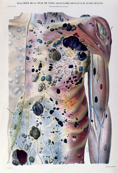 Tumours and cancerous tubercles, from Anatomie Pathologique du Corps Humain