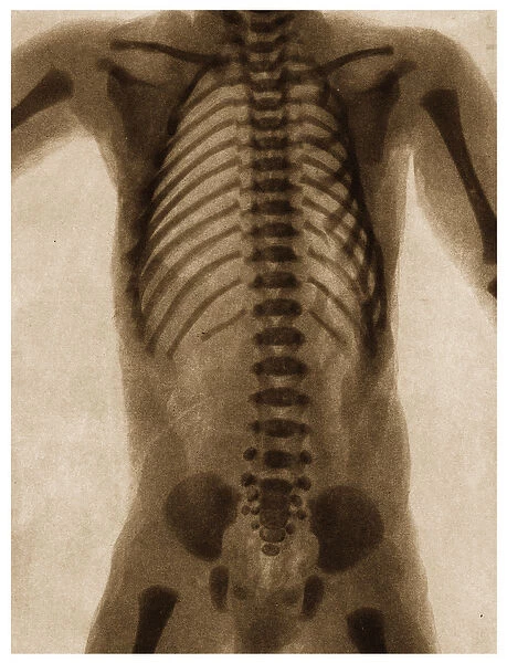X Ray of a human torso c. 1890