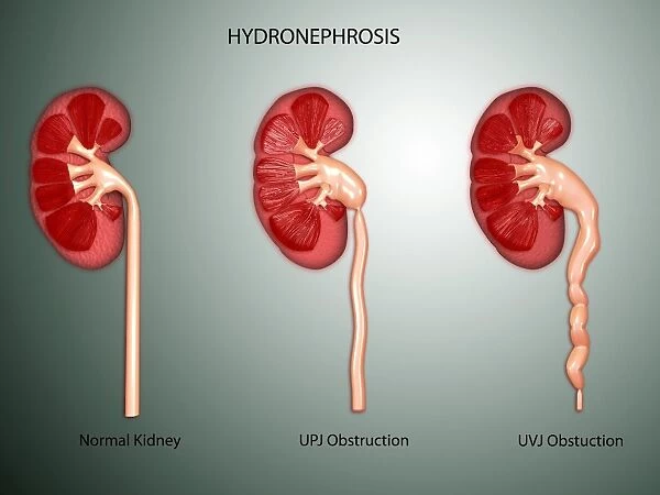 Hydronephrosis condition of the kidney