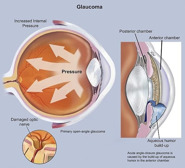 Retina of eye with glaucoma