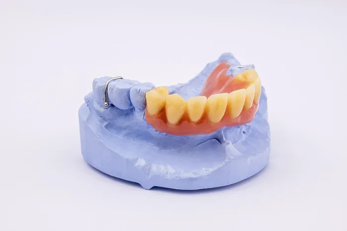 Framed Print : Removable Upper Jaw Denture Print Framed Print : Removable Upper Jaw Denture Print