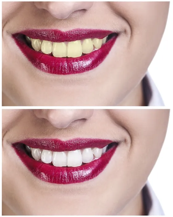 Framed Print : Teeth Print Before and After Bleaching Treatment Framed Print : Teeth Print Before and After Bleaching Treatment