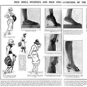 Foot x rays showing damage done by wearing high heels