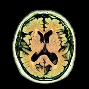 Alcoholic dementia, MRI scan