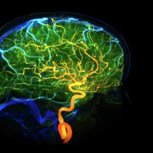 Brain blood vessels, 3D angiogram C007 / 1981