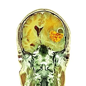 Brain cancer, MRI scan C016 / 4437