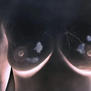 Breast lumps, MRI