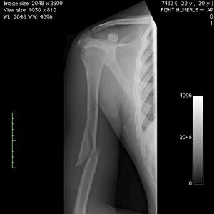 Broken arm bone, digital X-ray