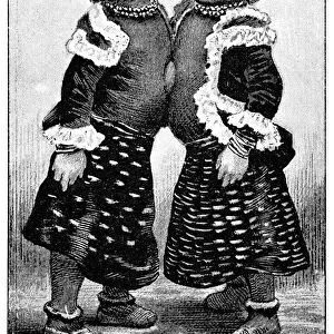 Conjoined twins, 1893