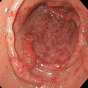 Gastric antral vascular ectasia C016 / 8328